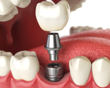 How Long Does the Dental Implant Process Take in Dubai (1)