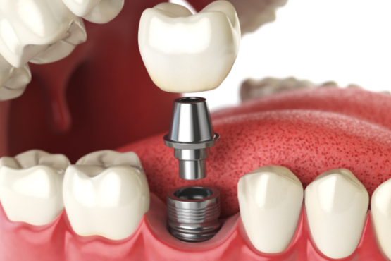 How Long Does the Dental Implant Process Take in Dubai (1)
