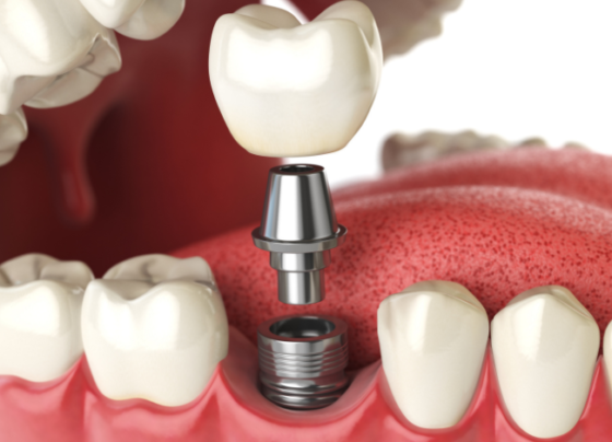 How Long Does the Dental Implant Process Take in Dubai (1)