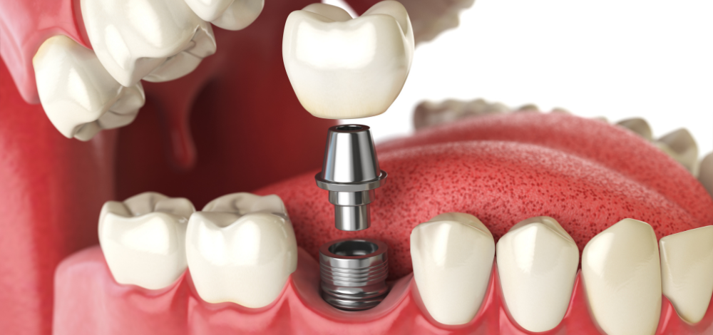 How Long Does the Dental Implant Process Take in Dubai?