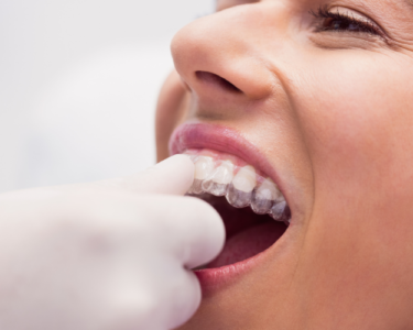 How Much Do Full Mouth Dental Implants Cost in Dubai