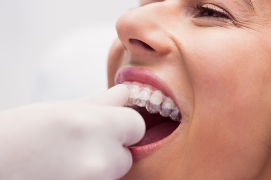 How Much Do Full Mouth Dental Implants Cost in Dubai