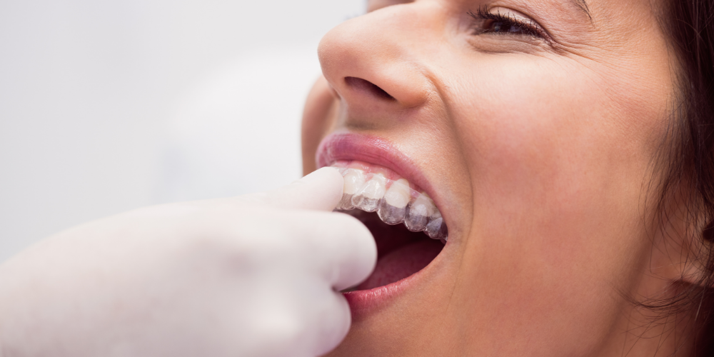 How Much Do Full Mouth Dental Implants Cost in Dubai?