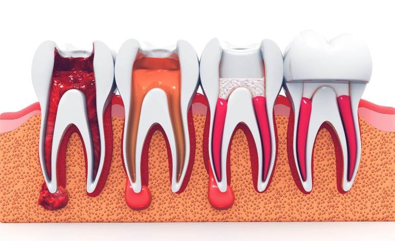 6 Signs of Infection After Root Canal Treatment