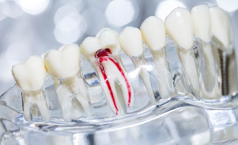 How Much Does a Root Canal Cost?