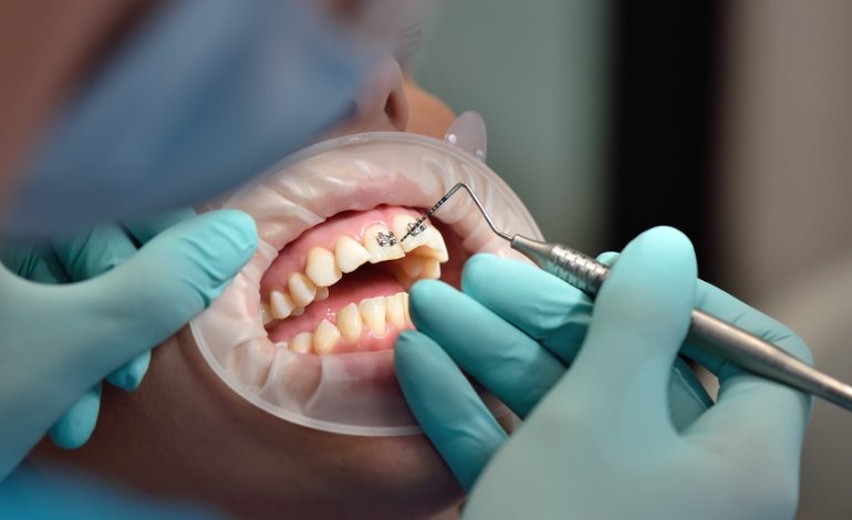 Signs of Infection After Root Canal Treatment: Dubai Patient Guide