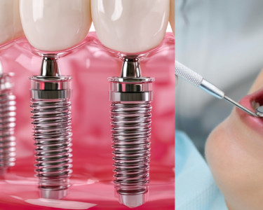 dental bridge or dental implant in Dubai