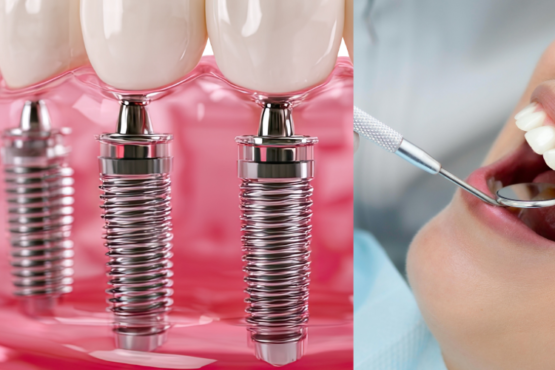 dental bridge or dental implant in Dubai