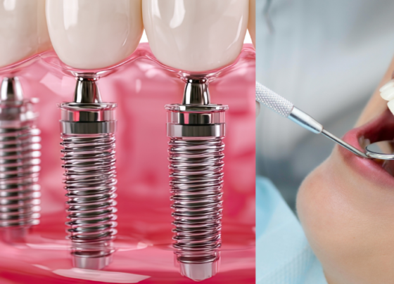dental bridge or dental implant in Dubai