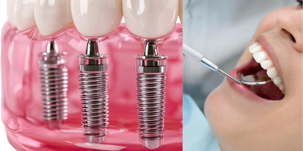 Dental Bridge or Dental Implant: Which Is Better in Dubai?