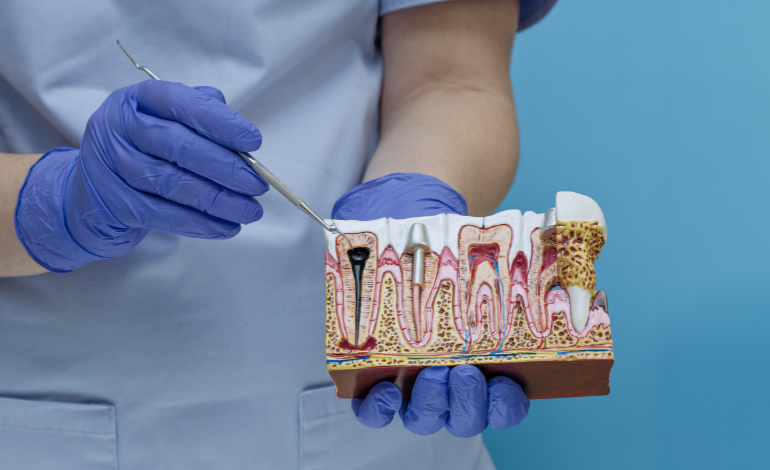 Do I Need a Root Canal or Filling? Dubai Patient Guide