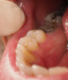 how long will a tooth hurt before the nerve dies