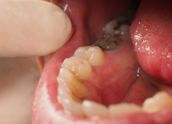 how long will a tooth hurt before the nerve dies
