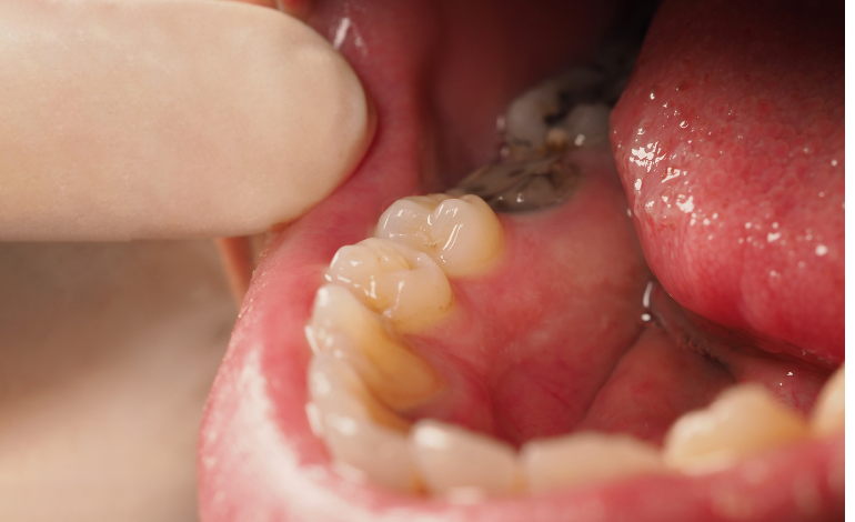 How Long Will a Tooth Hurt Before the Nerve Dies? Dubai Patient Guide